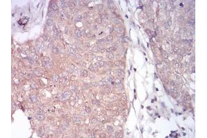 Immunohistochemical analysis of paraffin-embedded bladder cancer tissues using PLCG1 mouse mAb with DAB staining.