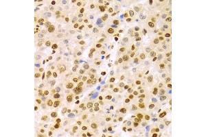 Immunohistochemistry of paraffin-embedded human liver cancer using DKC1 Antibody (ABIN5970956) at dilution of 1/100 (40x lens). (DKC1 anticorps)