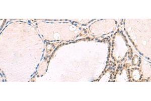 Immunohistochemistry of paraffin-embedded Human thyroid cancer tissue using RNF13 Polyclonal Antibody at dilution of 1:60(x200) (RNF13 anticorps)
