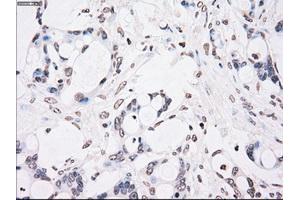 Immunohistochemical staining of paraffin-embedded Adenocarcinoma of colon tissue using anti-CHEK2mouse monoclonal antibody. (CHEK2 anticorps)