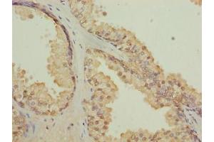 Immunohistochemistry of paraffin-embedded human prostate cancer using ABIN7147501 at dilution of 1:100 (CGGBP1 anticorps  (AA 1-167))