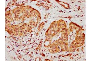 IHC image of ABIN7156000 diluted at 1:500 and staining in paraffin-embedded human pancreatic cancer performed on a Leica BondTM system.