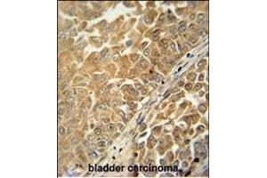 C antibody (Center) (ABIN654959 and ABIN2844598) immunohistochemistry analysis in formalin fixed and paraffin embedded human bladder carcinoma followed by peroxidase conjugation of the secondary antibody and DAB staining. (C18ORF25 anticorps  (AA 163-191))
