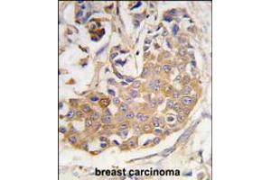 Formalin-fixed and paraffin-embedded human breast carcinoma tissue reacted with COL9A1 antibody , which was peroxidase-conjugated to the secondary antibody, followed by DAB staining. (COL9A1 anticorps  (AA 428-456))