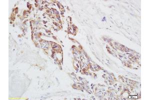 Formalin-fixed and paraffin embedded human rectal carcinoma labeled with Anti-Ensconsin Polyclonal Antibody, Unconjugated  at 1:200 followed by conjugation to the secondary antibody and DAB staining (MAP7 anticorps  (AA 151-250))