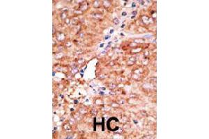 Formalin-fixed and paraffin-embedded human hepatocellular carcinoma tissue reacted with CCBP2 polyclonal antibody  , which was peroxidase-conjugated to the secondary antibody, followed by AEC staining. (CCBP2 anticorps  (C-Term))