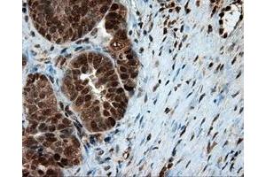 Immunohistochemical staining of paraffin-embedded Adenocarcinoma of colon tissue using anti-LTA4H mouse monoclonal antibody. (LTA4H anticorps)