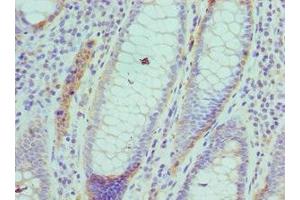 Immunohistochemistry of paraffin-embedded human colon cancer using ABIN7143460 at dilution of 1: 100 (ARFGAP1 anticorps  (AA 1-220))