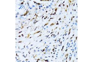 Immunohistochemistry of paraffin-embedded human gastric cancer using XRCC4 antibody (ABIN3022381, ABIN3022382, ABIN3022383 and ABIN6218772) at dilution of 1:100 (40x lens).