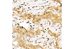 Immunohistochemistry of paraffin-embedded human breast cancer using GPS1 Rabbit pAb (ABIN6127934, ABIN6141361, ABIN6141362 and ABIN6222653) at dilution of 1:250 (40x lens).