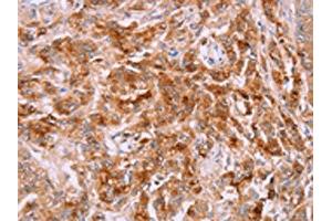 The image on the left is immunohistochemistry of paraffin-embedded Human prostate cancer tissue using ABIN7191308(LPCAT4 Antibody) at dilution 1/15, on the right is treated with synthetic peptide. (LPCAT4 anticorps)