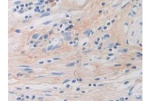 Detection of POSTN in Human Colorectal cancer Tissue using Polyclonal Antibody to Periostin (POSTN)