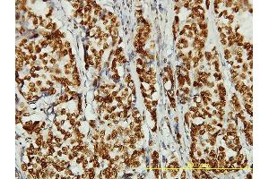 Immunoperoxidase of monoclonal antibody to KIAA0056 on formalin-fixed paraffin-embedded human breast cancer tissue. (NCAPD3 anticorps  (AA 1-341))