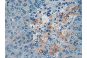 Detection of CEA in Human Liver cancer Tissue using Polyclonal Antibody to Carcinoembryonic Antigen (CEA)