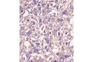 (ABIN652875 and ABIN2842566) staining HP in human epatocarcinoma sections by Immunohistochemistry (IHC-P - paraformaldehyde-fixed, paraffin-embedded sections). (Haptoglobin anticorps  (Center))