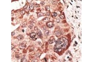IHC analysis of FFPE human hepatocarcinoma tissue stained with the Recoverin antibody (Recoverin anticorps  (AA 169-200))