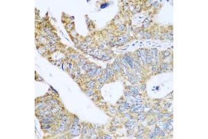 Immunohistochemistry of paraffin-embedded human colon carcinoma using GLUD1 antibody (ABIN5975614) at dilution of 1/100 (40x lens).