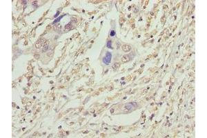 Immunohistochemistry of paraffin-embedded human pancreatic cancer using ABIN7175336 at dilution of 1:100