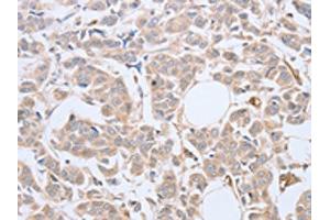 The image on the left is immunohistochemistry of paraffin-embedded Human breast cancer tissue using ABIN7128138(ABHD5 Antibody) at dilution 1/10, on the right is treated with fusion protein. (ABHD5 anticorps)