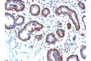 Formalin-fixed, paraffin-embedded human Breast Carcinoma stained with Ferritin LC Rabbit Recombinant Monoclonal Antibody (FTL/2338R).