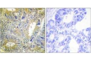 Immunohistochemistry analysis of paraffin-embedded human colon carcinoma tissue, using Desmin (Ab-60) Antibody. (Desmin anticorps  (AA 26-75))