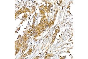 Immunohistochemistry of paraffin-embedded human breast cancer using UQCRH Rabbit mAb (ABIN7271126) at dilution of 1:50 (40x lens). (UQCRH anticorps)