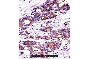 N Antibody (C-term) ((ABIN389343 and ABIN2839452))immunohistochemistry analysis in formalin fixed and paraffin embedded human colon carcinoma followed by peroxidase conjugation of the secondary antibody and DAB staining. (NPM1 anticorps  (C-Term))