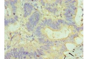 Immunohistochemistry of paraffin-embedded human colon cancer using ABIN7145506 at dilution of 1:100 (Glucuronidase beta anticorps  (AA 382-651))