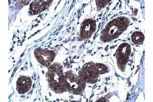 IHC-P Image RANKL antibody [C2C3], C-term detects RANKL protein at membrane on human breast carcinoma by immunohistochemical analysis. (RANKL anticorps  (C-Term))