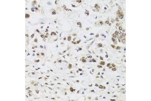 Immunohistochemistry of paraffin-embedded human gastric cancer using PPP1CC antibody. (PPP1CC anticorps)