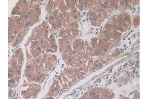 IHC-P analysis of Human Glioma Tissue, with DAB staining. (PAI1 anticorps  (AA 25-402))