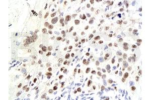 Formalin-fixed and paraffin embedded human laryngeal squamous cell carcinoma labeled Anti-P21/CDKN1A Polyclonal Antibody, Unconjugated (ABIN672606) at 1:200, followed by conjugation to the secondary antibody and DAB staining (p21 anticorps  (AA 101-164))
