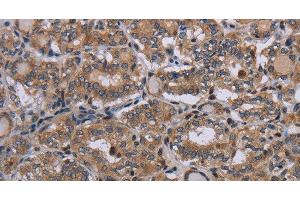 Immunohistochemistry of paraffin-embedded Human thyroid cancer using P2RX2 Polyclonal Antibody at dilution of 1:50 (P2RX2 anticorps)