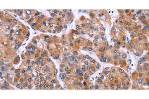 Immunohistochemistry of paraffin-embedded Human liver cancer tissue using MSMO1 Polyclonal Antibody at dilution 1:40