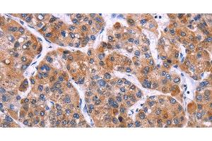 Immunohistochemistry of paraffin-embedded Human liver cancer tissue using MSMO1 Polyclonal Antibody at dilution 1:40 (SC4MOL anticorps)