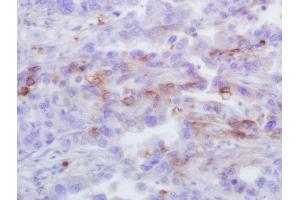 Formalin-fixed and paraffin embedded human lung carcinoma labeled with Rabbit Anti-CXCL1 Polyclonal Antibody, Unconjugated (ABIN2173443) at 1:200 followed by conjugation to the secondary antibody and DAB staining (CXCL1 anticorps  (AA 51-107))