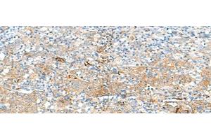 Immunohistochemistry of paraffin-embedded Human cervical cancer tissue using HLA-DRB3 Polyclonal Antibody at dilution of 1:50(x200) (HLA-DRB3 anticorps)