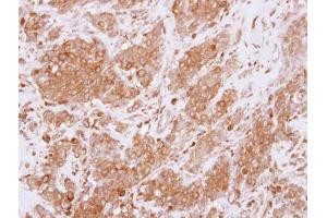 IHC-P Image Immunohistochemical analysis of paraffin-embedded human breast cancer, using RGS10, antibody at 1:250 dilution. (RGS10 anticorps)