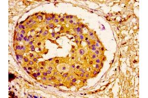 IHC image of ABIN7143742 diluted at 1:100 and staining in paraffin-embedded human breast cancer performed on a Leica BondTM system. (ORM1 anticorps  (AA 19-201))