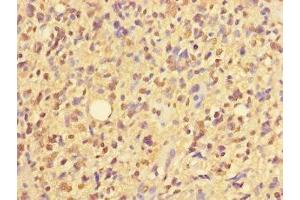 Immunohistochemistry of paraffin-embedded human glioma using ABIN7176377 at dilution of 1:100 (ZNF559 anticorps  (AA 1-300))