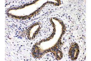 GAD65 was detected in paraffin-embedded sections of human mammary cancer tissues using rabbit anti- GAD65 Antigen Affinity purified polyclonal antibody (Catalog #) at 1 µg/mL.