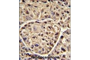 Formalin-fixed and paraffin-embedded human hepatocarcinoma reacted with ELOVL6 Antibody (N-term), which was peroxidase-conjugated to the secondary antibody, followed by DAB staining. (ELOVL6 anticorps  (N-Term))