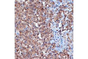 Immunohistochemistry of paraffin-embedded human thyroid cancer using PKC delta Rabbit mAb  at dilution of 1:100 (40x lens). (PKC delta anticorps)