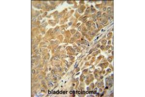 CR025 antibody immunohistochemistry analysis in formalin fixed and paraffin embedded human bladder carcinoma followed by peroxidase conjugation of the secondary antibody and DAB staining. (C18ORF25 anticorps  (AA 163-191))
