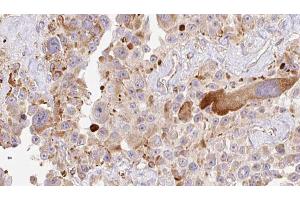 ABIN6274010 at 1/100 staining Human Melanoma tissue by IHC-P. (HAPLN1 anticorps  (N-Term))