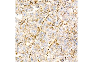 Immunohistochemistry of paraffin-embedded human liver cancer using Annexin  Rabbit pAb  at dilution of 1:25 (40x lens). (Annexin A2 anticorps)