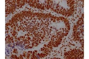 IHC image of ABIN7127571 diluted at 1:100 and staining in paraffin-embedded human ovarian cancer performed on a Leica BondTM system. (Recombinant Interleukin enhancer-binding factor 3 (ILF3) anticorps)