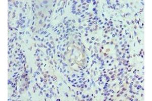 Immunohistochemistry of paraffin-embedded human breast cancer using ABIN7174459 at dilution of 1:100 (UBE2J2 anticorps  (AA 1-230))