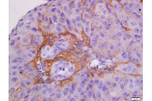 Formalin-fixed and paraffin embedded human laryngocarcinoma labeled with Anti-CK7 Polyclonal Antibody, Unconjugated  at 1:300 followed by conjugation to the secondary antibody and DAB staining. (Cytokeratin 7 anticorps  (AA 251-350))