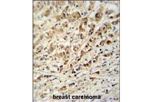 AVL9 Antibody (C-term) (ABIN651037 and ABIN2840044) immunohistochemistry analysis in formalin fixed and paraffin embedded human breast carcinoma followed by peroxidase conjugation of the secondary antibody and DAB staining. (AVL9 anticorps  (C-Term))